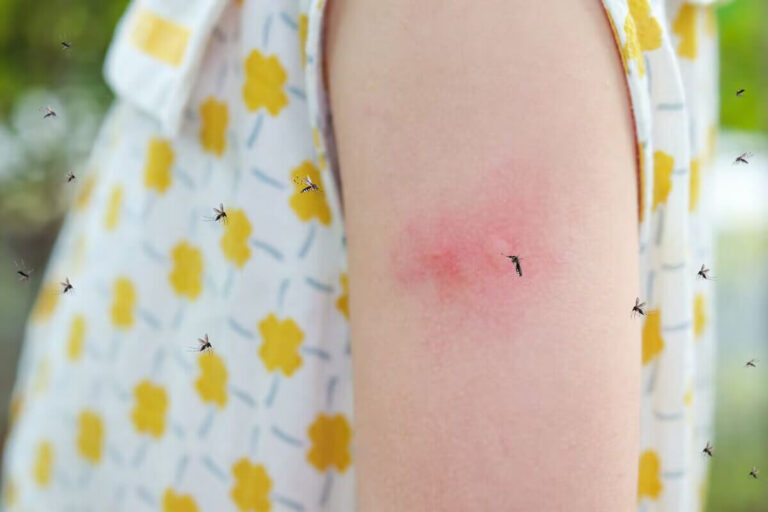 What Do Mosquito Bites Look Like?