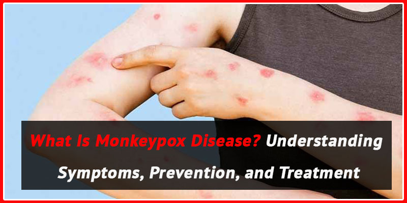 Monkeypox-Disease-Understanding-the-Symptoms,-Prevention,-and-Treatment