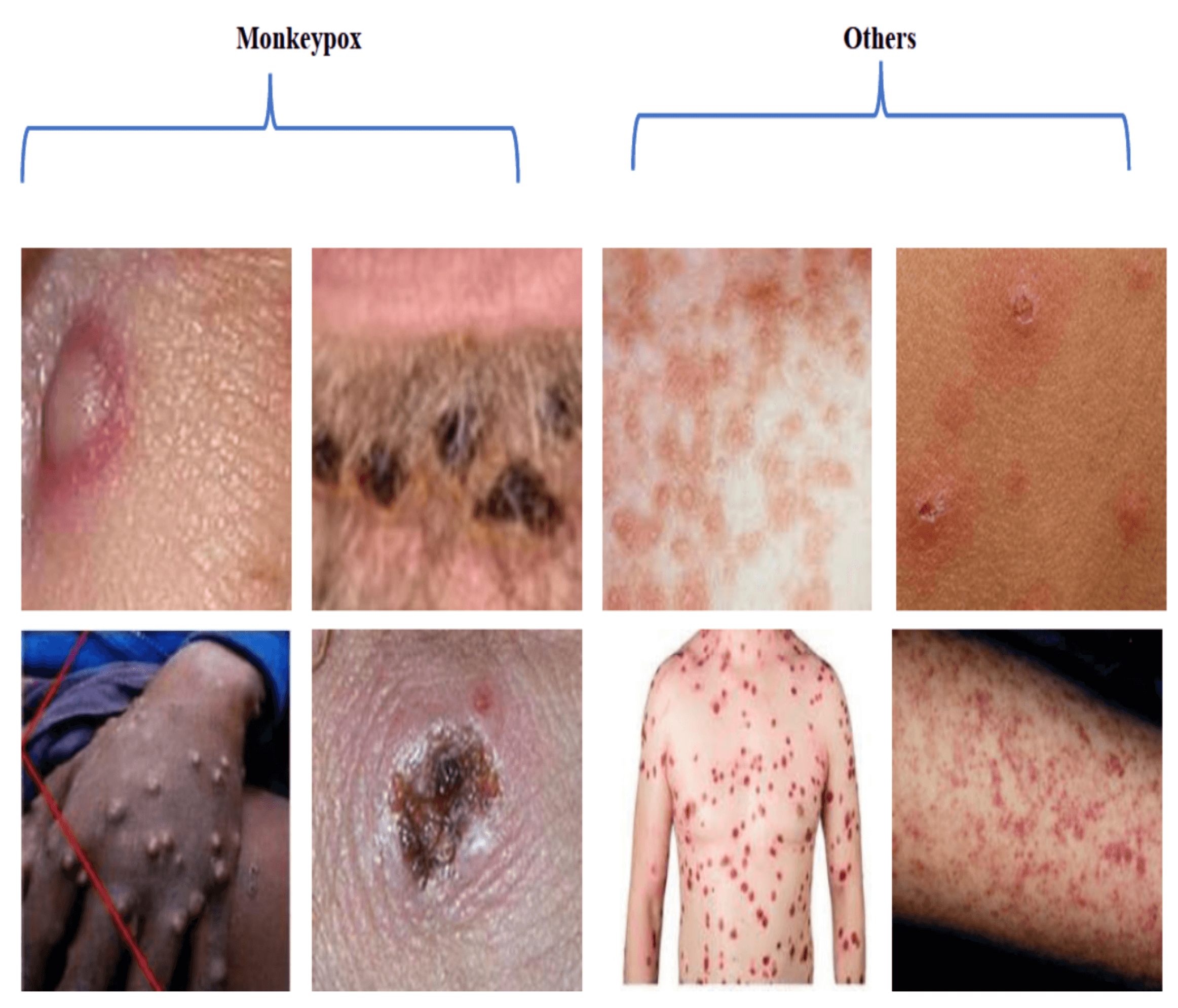 monkeypox disease mpox symptoms