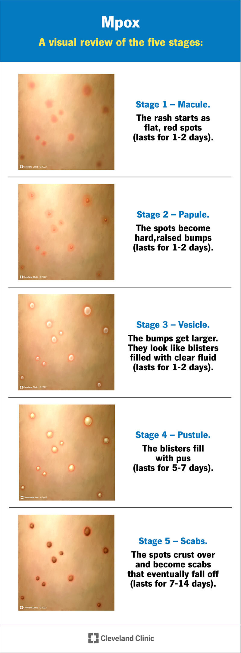 monkeypox disease mpox visual development stages